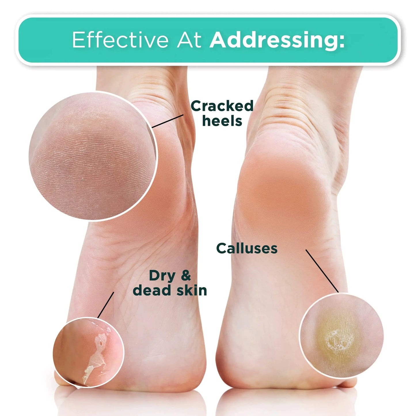 DERMORA Foot Peel Mask – 2 Pack French Lavender Exfoliating Foot Masks for Soft, Smooth Feet